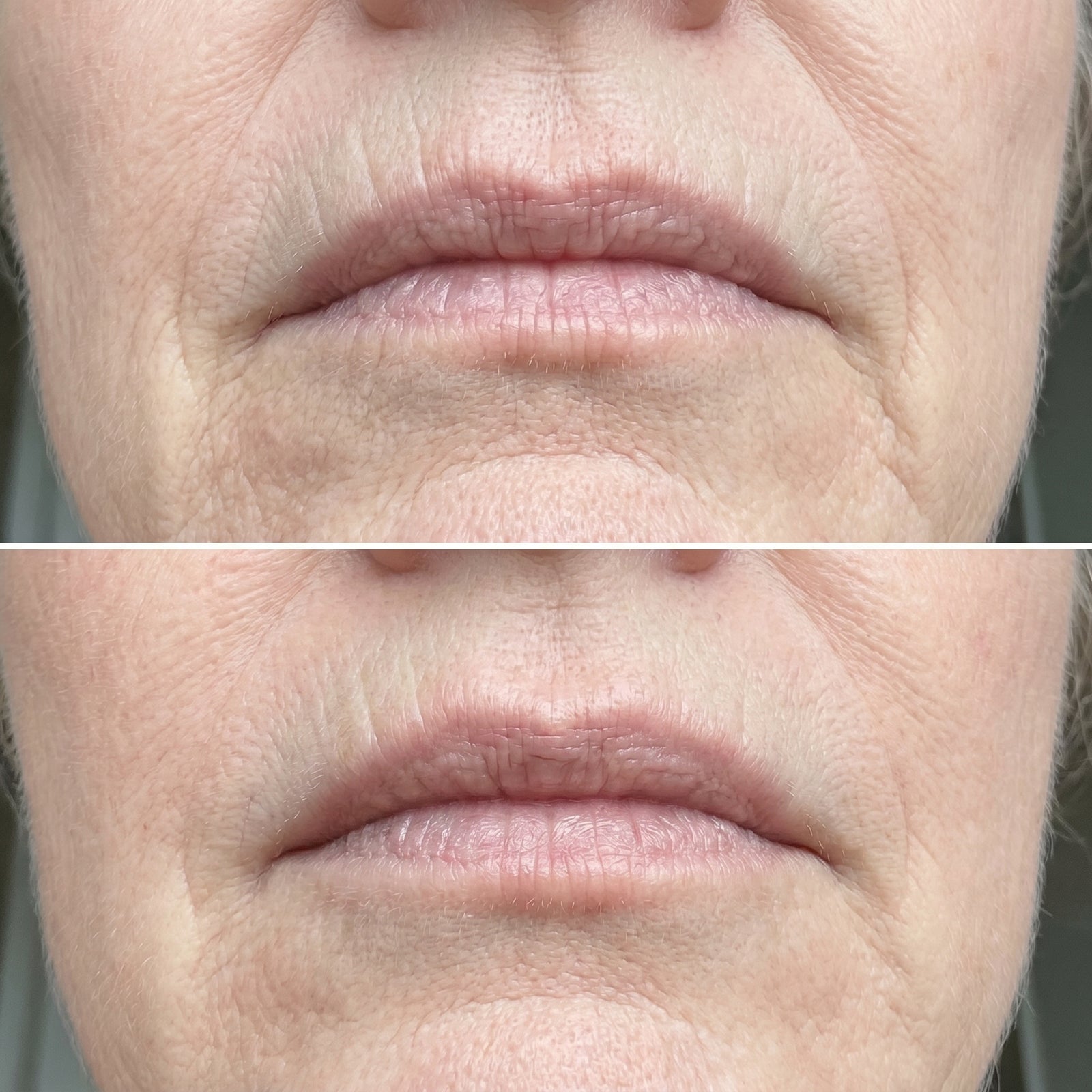 20 Years of Lip Lines Gone In 3 Minutes !