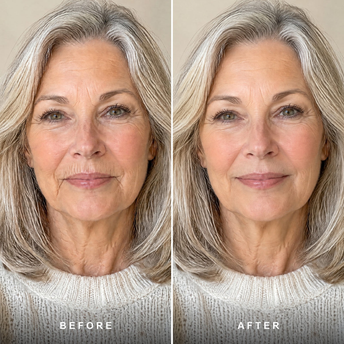 The lines above her lip, before and after éline